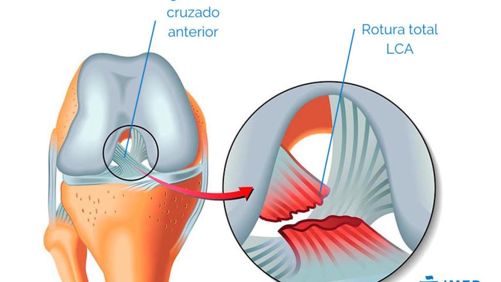 J C Ferragut Imed Las Mujeres Son M S Propensas A Sufrir La Rotura