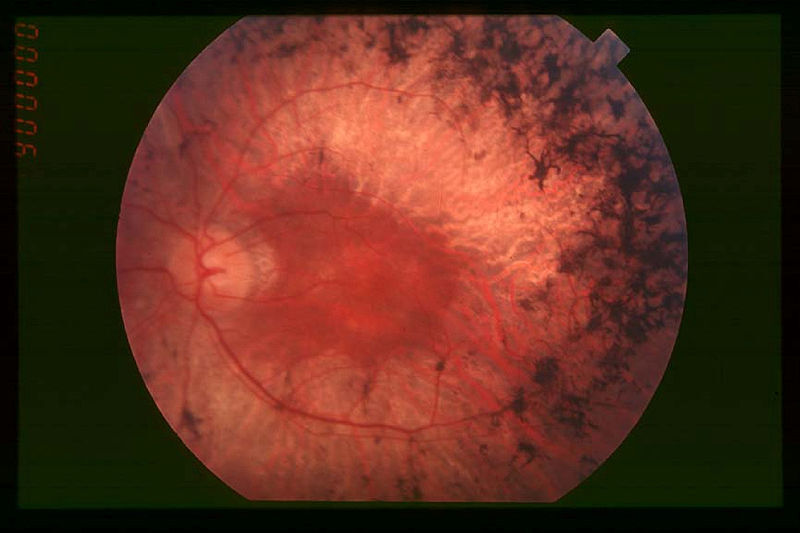 retinosis-pigmentaria-1