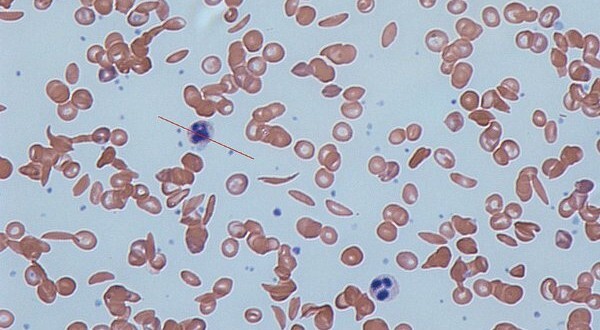 anemia