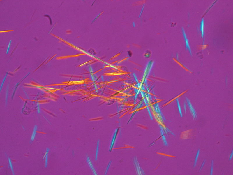 cristales-acido-urico