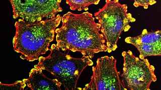 Células de melanoma metastásico.