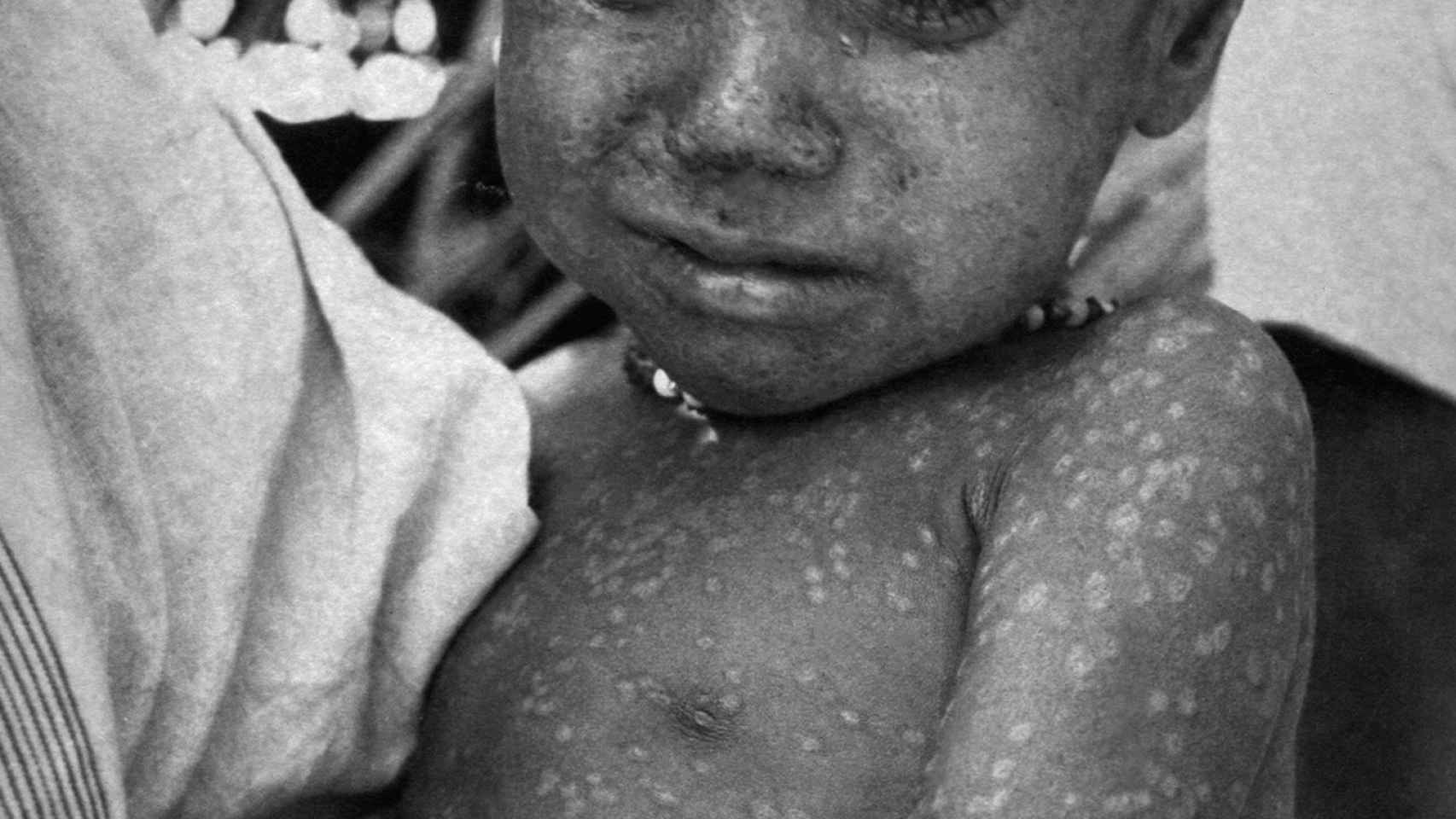 La niña Rahima Banu, última afectada por la viruela.