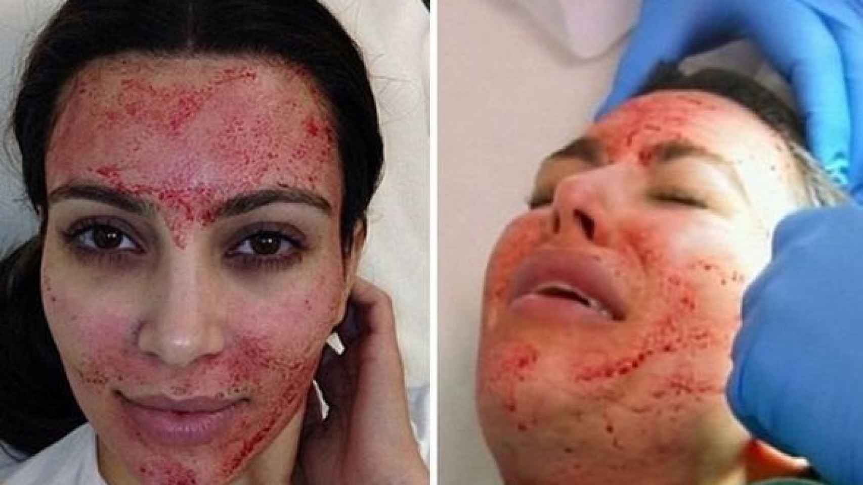 Kim Kardashian mientras es sometida al tratamiento Vampire Breast Lift