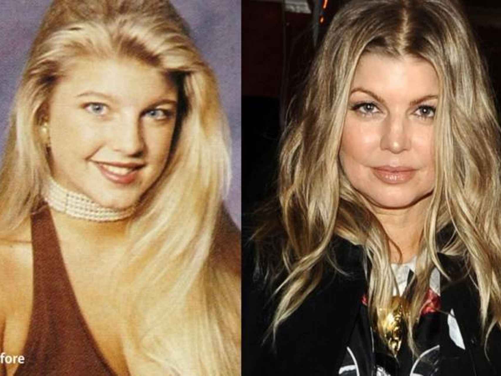 La cantante de Fergie antes y después de operarse