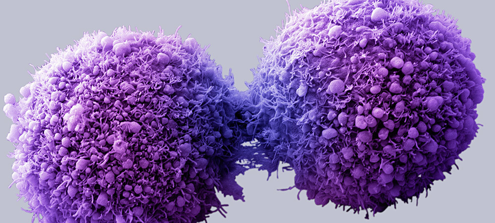 celula-cancer