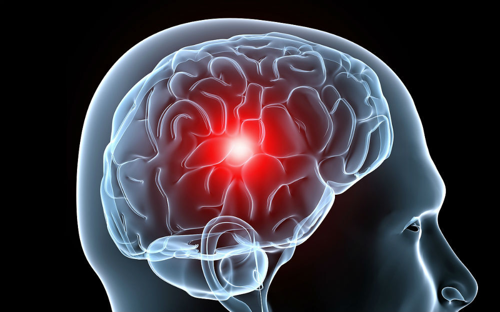 migrana_cerebro