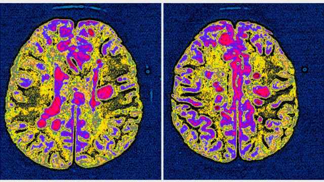 Una resonancia de un cerebro afectado por esclerosis múltiple.