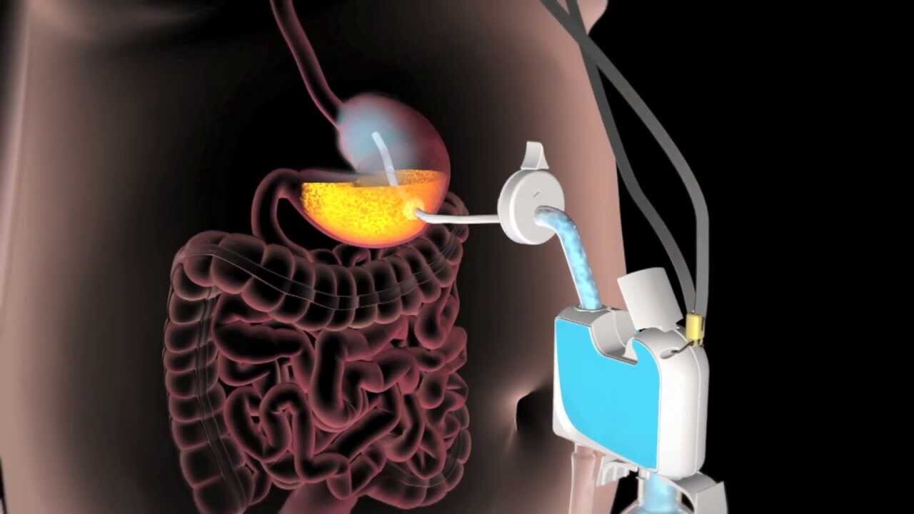 AspireAssist