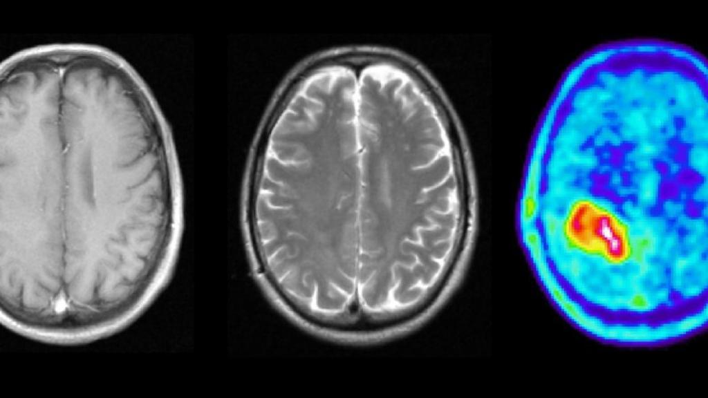 Golpe Español Al Tumor Cerebral Más Letal Se Puede Frenar Con Fármacos