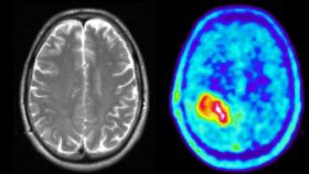 Una prueba diagnóstica muestra un tumor cerebral.