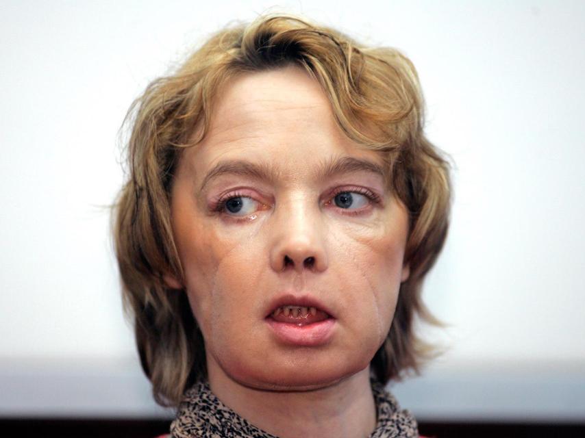 Isabelle Dinoire, un año después del trasplante