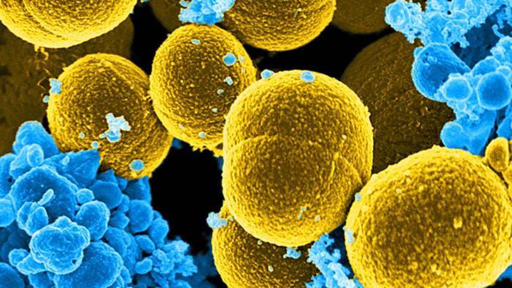 La bacteria Staphylococcus Aureus es causa frecuente de neumonía.