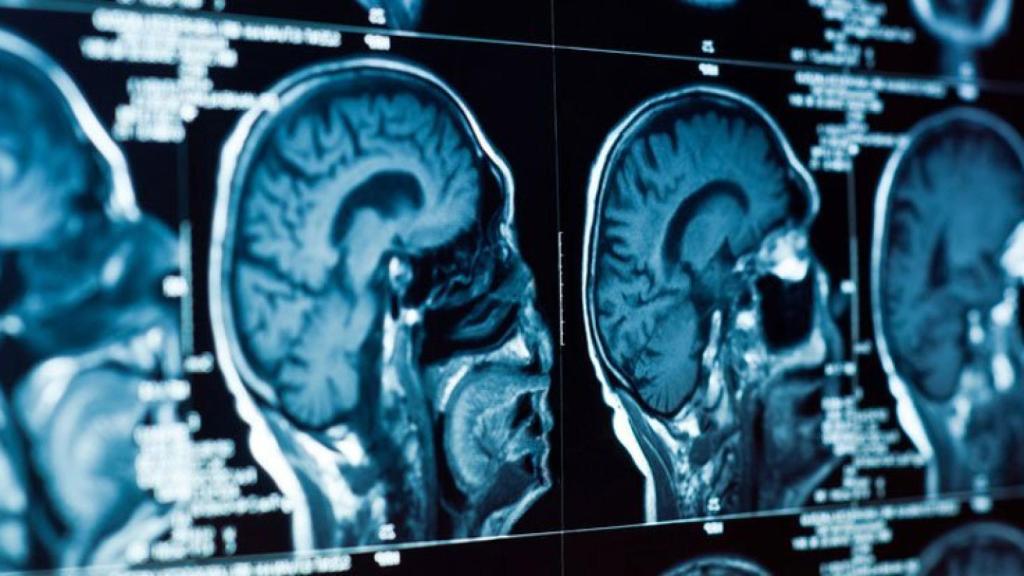cerebro_depresion