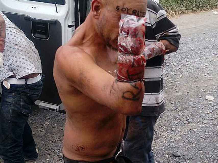 Una de las víctimas a las que les han amputado las manos, en la colonia Solidaridad del municipio de Tlaquepaque.