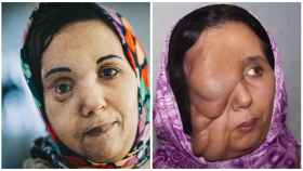El ahora y el antes de Samira, que se ha puesto en manos del doctor Cavadas para que le extirpara el tumor que deformaba su rostro.