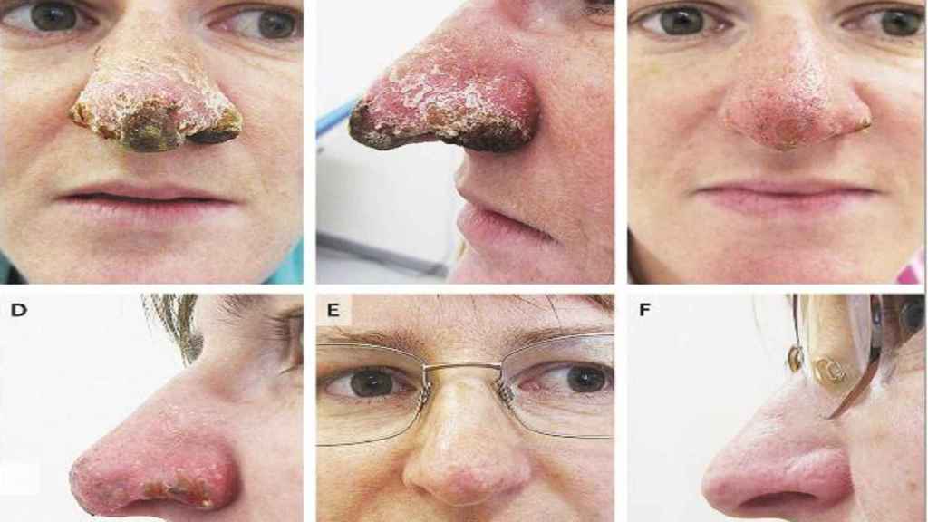 Diversas imágenes de la nariz de la paciente