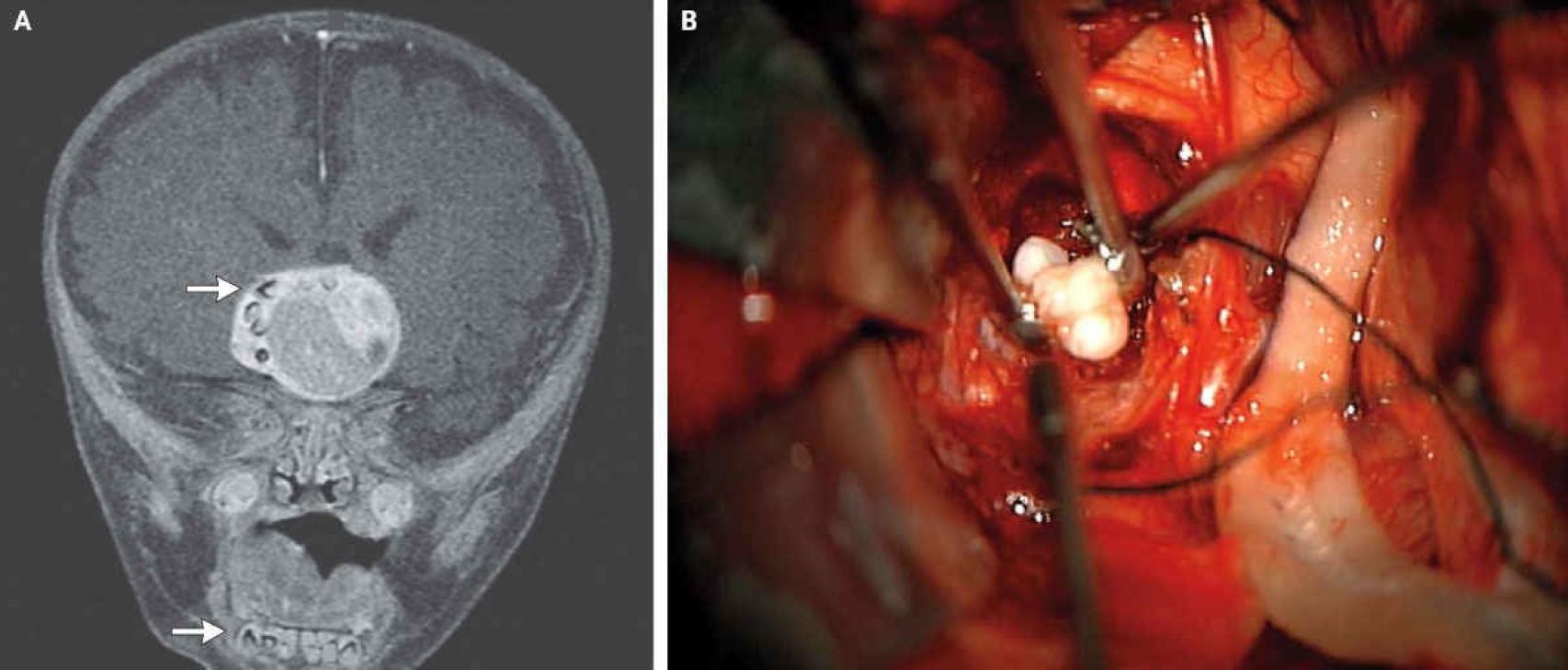 Un craneofaringioma en el cerebro.