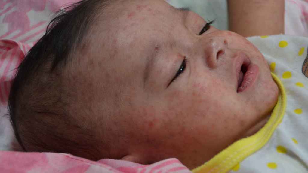Un bebé con sarampión.