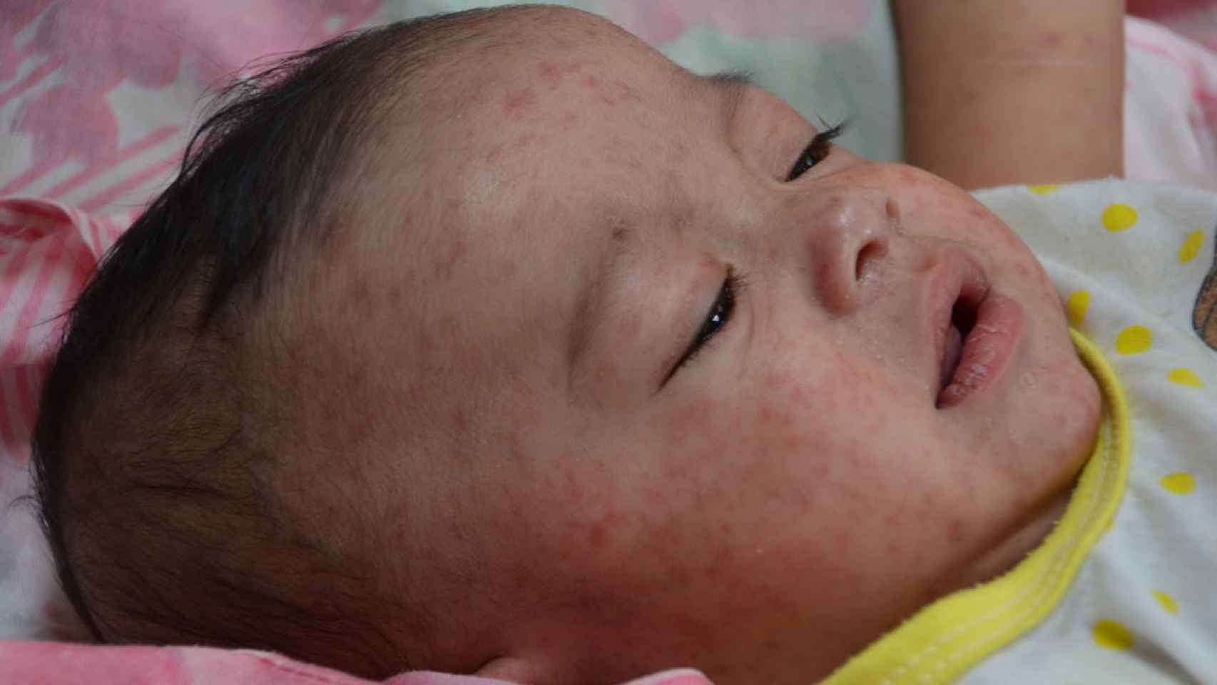 Un bebé con sarampión.