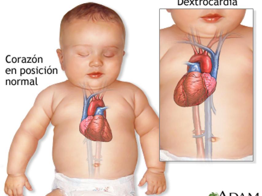 Explicación visual de la dextrocardia.