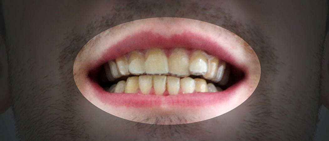 ortodoncia impresion 3d 2