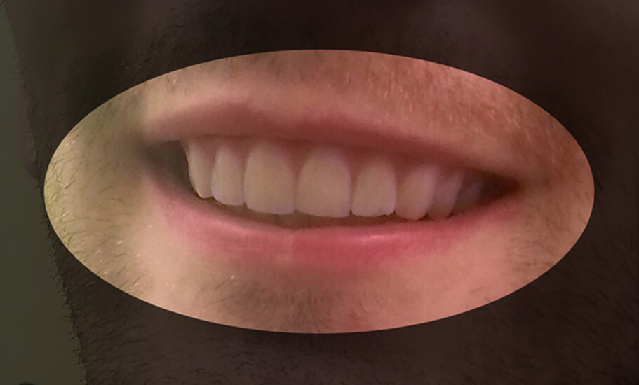ortodoncia impresion 3d 3