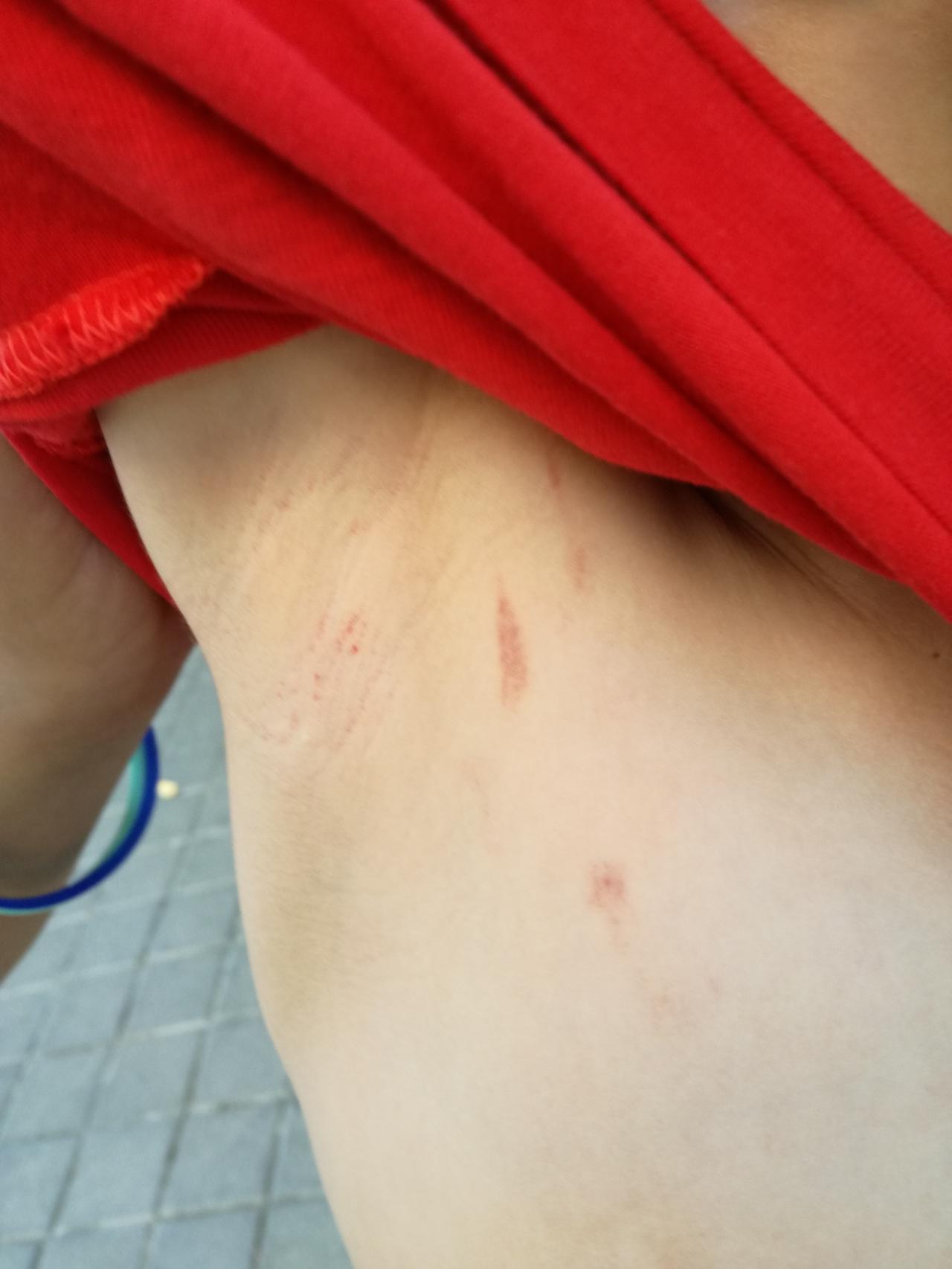 Así quedo la axila de Nacho tras la agresión.