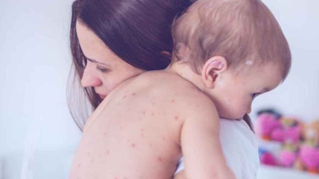 Una madre abraza a su niño con sarampión.
