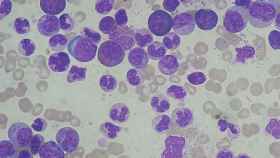 Sangre al microscopio de un afectado por leucemia