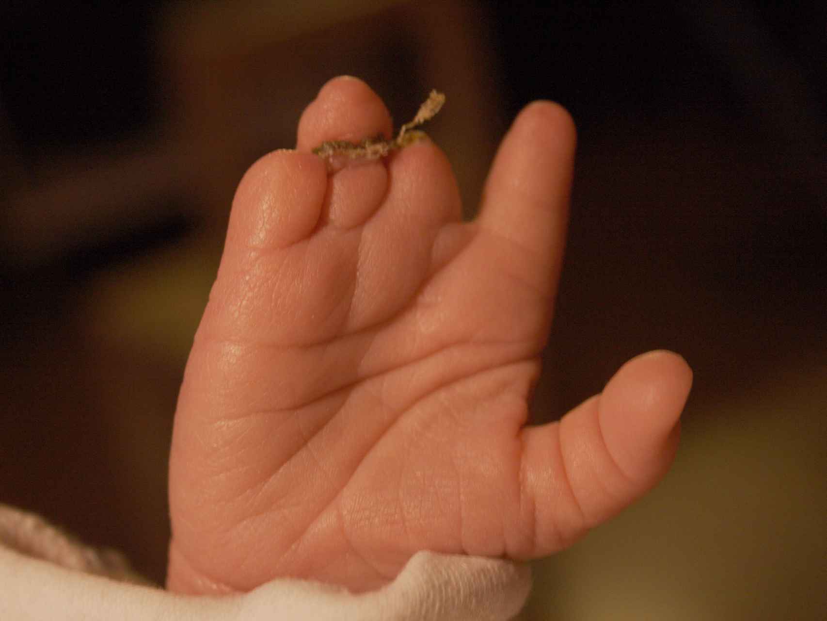Mano de un bebé afectado por el síndrome de bridas amnióticas.