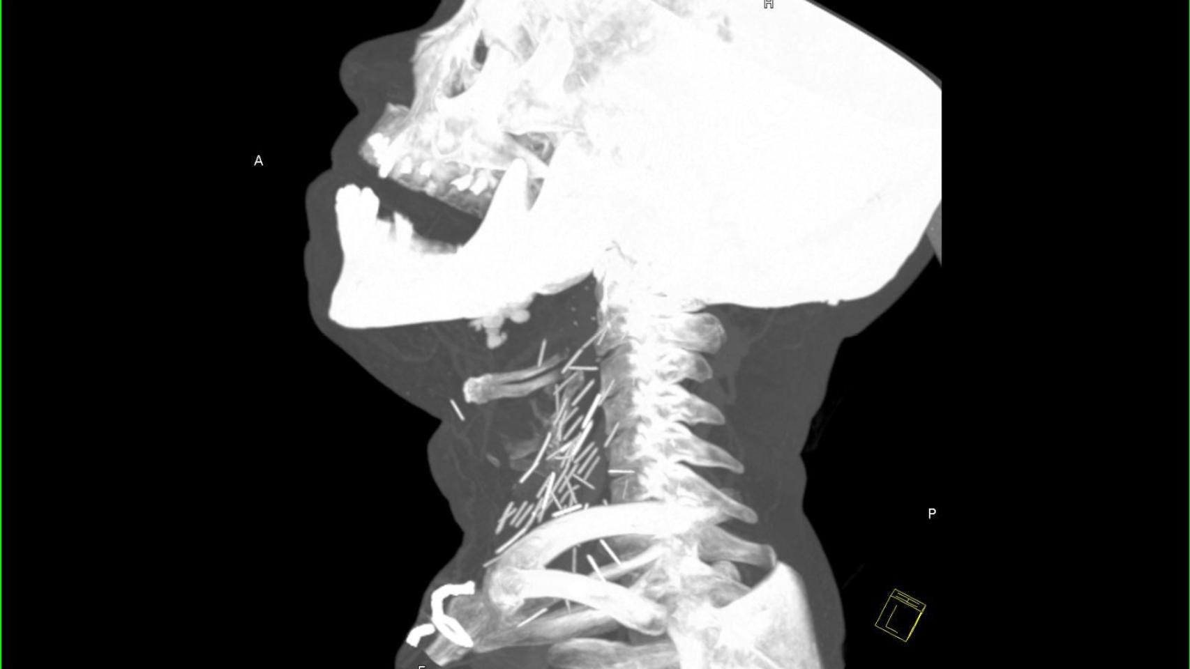 Подъязычная кость рентген