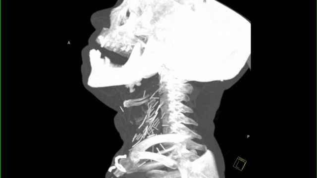 Radiografía de un hombre con agujas rotas incrustadas en el cuello.
