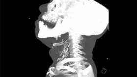 Radiografía de un hombre con agujas rotas incrustadas en el cuello.