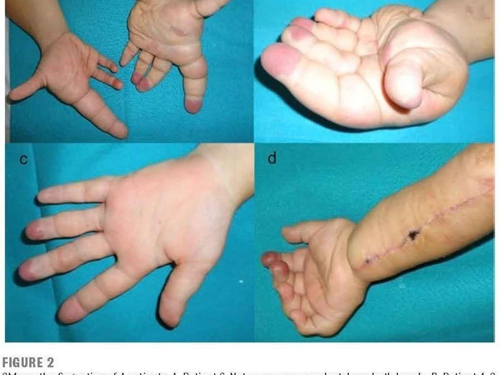 Dos pacientes con macrodactilia, un con las puntas de los dedos deformada y un operado vascularmente.