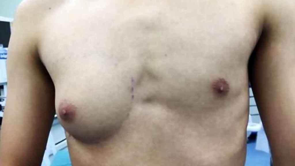 El pecho del joven chino con ginecomastia antes de ser intervenido quirúrgicamente.