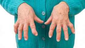 Fotografía de las manos de una mujer afectada por artritis reumatoide.