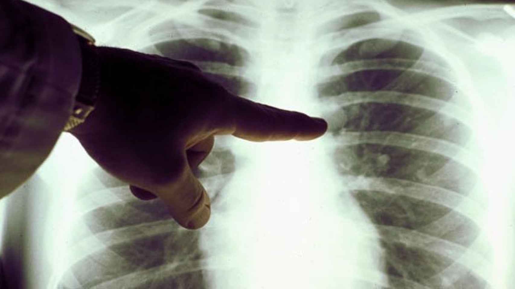 Imagen de archivo de un cáncer de pulmón.