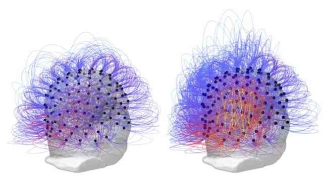 Imagen del cerebro antes y después del procedimiento.