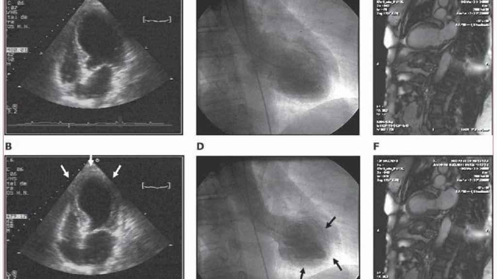Un ecocardiograma en las primeras horas de una miocardiopatía de takotsubo.