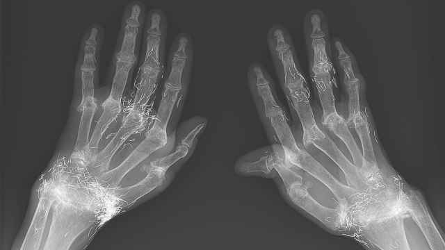 La radiografía de las manos de la mujer.