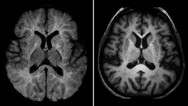 Un cerebro humano visto a través de una resonancia magnética.