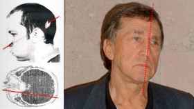 Anatoli Bugorski tras del accidente, y décadas después: la parte izquierda de su cara no ha envejecido.