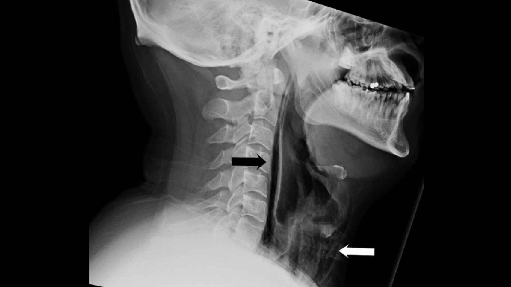 Las lesiones y la entrada de aire en la garganta del paciente.