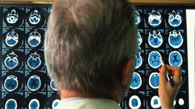 Un médico revisa imágenes del cerebro de un paciente de alzhéimer.