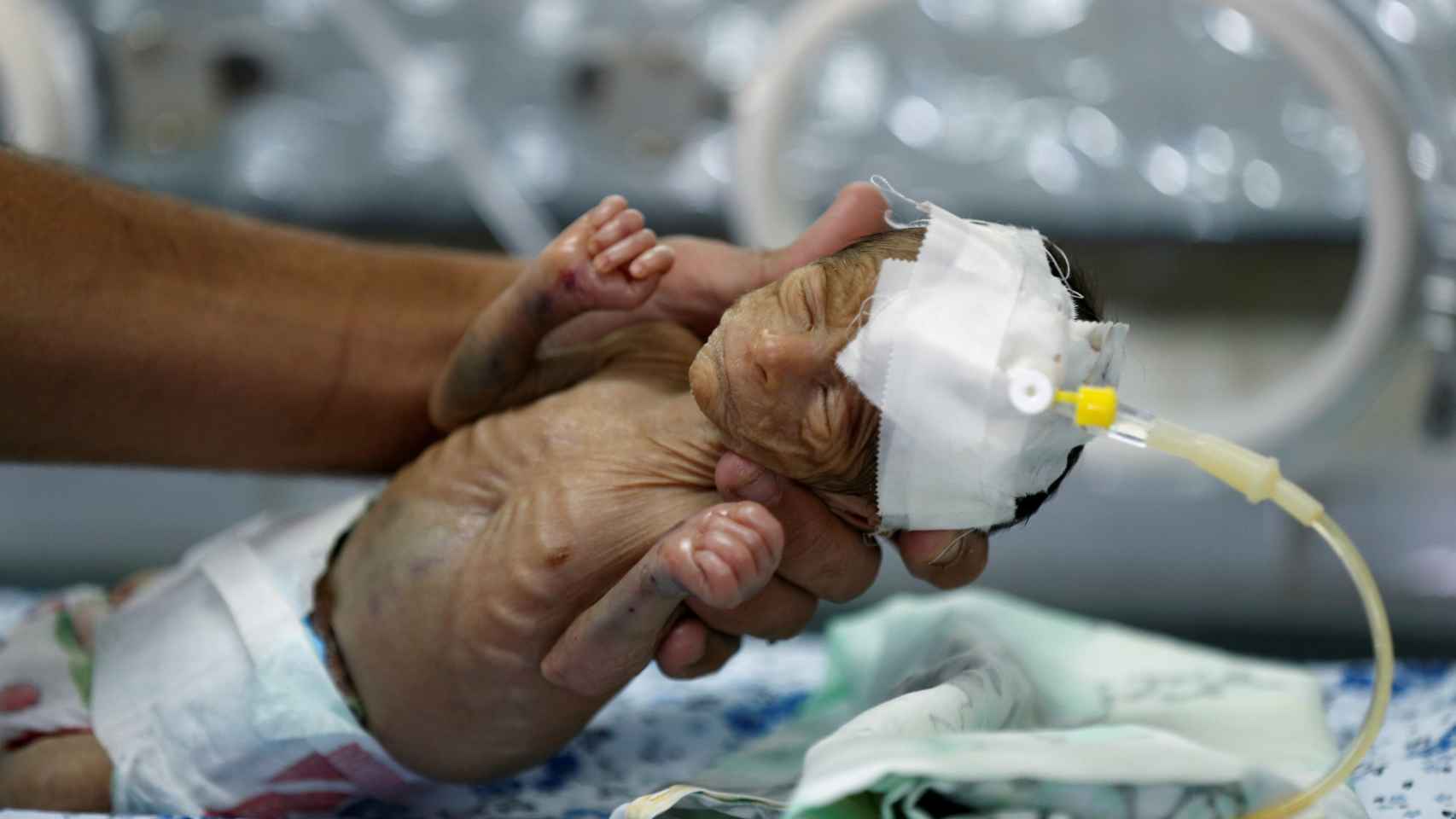Un bebé prematuro en un hospital de Sanaa. En Yemen un 30% de los recién nacidos son prematuros