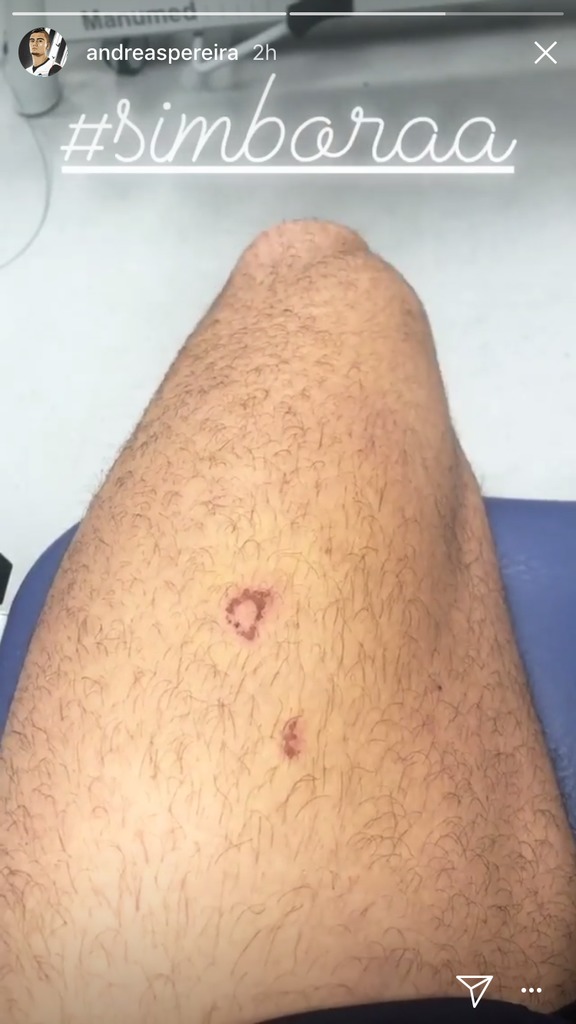 Andreas Pereira muestra sus heridas tras la brutal patada de Sergi Roberto