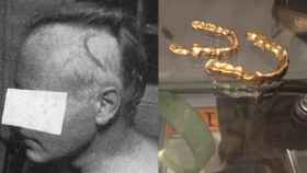 Alvin Graves, un mes después del accidente, junto a las fundas de oro que se usaron para contener la radiación.