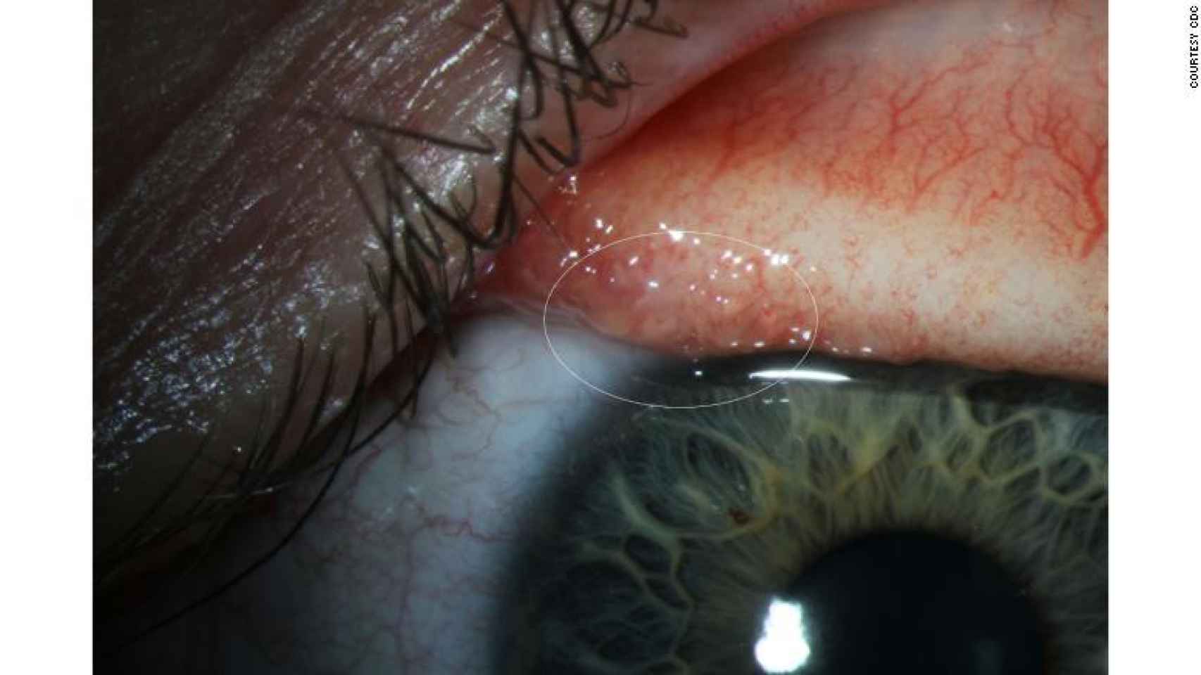 Los gusanos y larvas bajo el ojo de Abby Beckley.