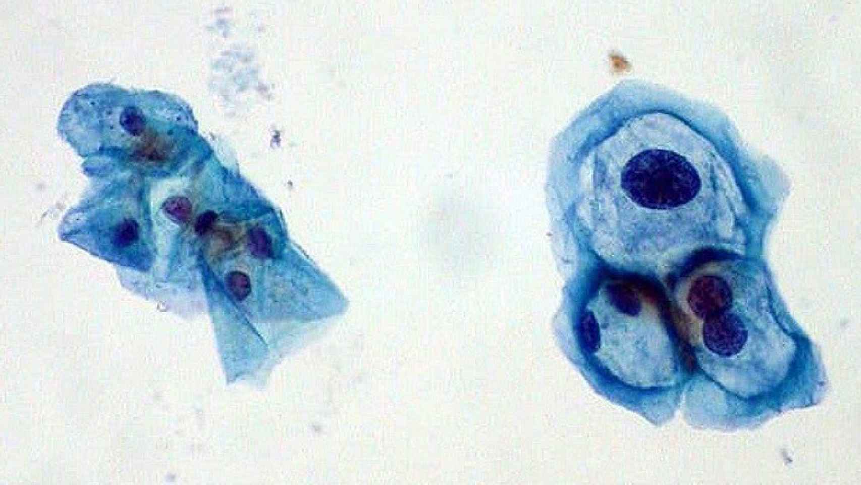 Regional-virus-papiloma-cancer-mujer