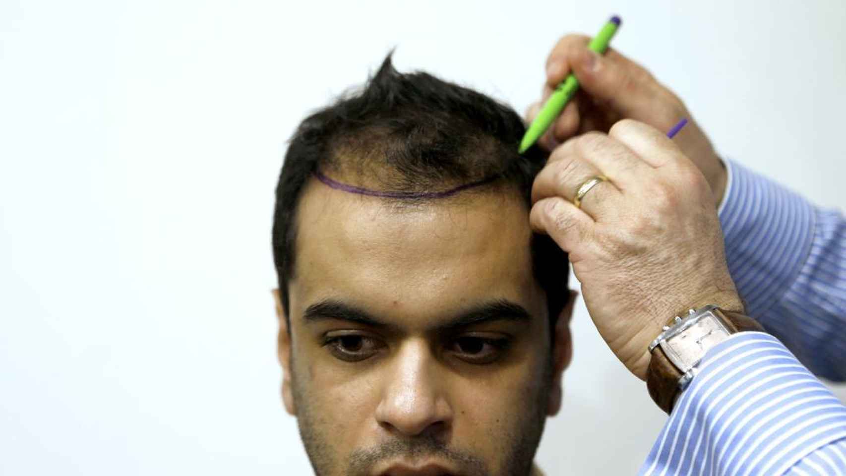 Un doctor examina a un paciente que someterá a un implante de pelo en una clínica tuca
